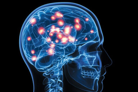 Epilepsi
